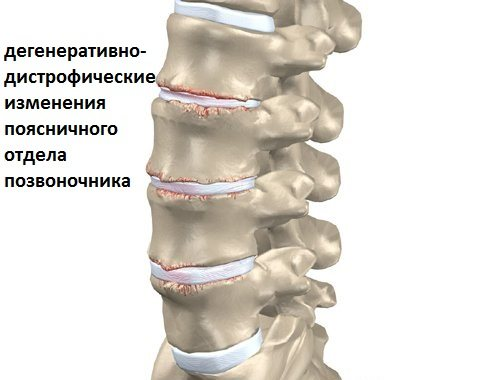 Дегенеративно-дистрофические изменения шейного отдела позвоночника