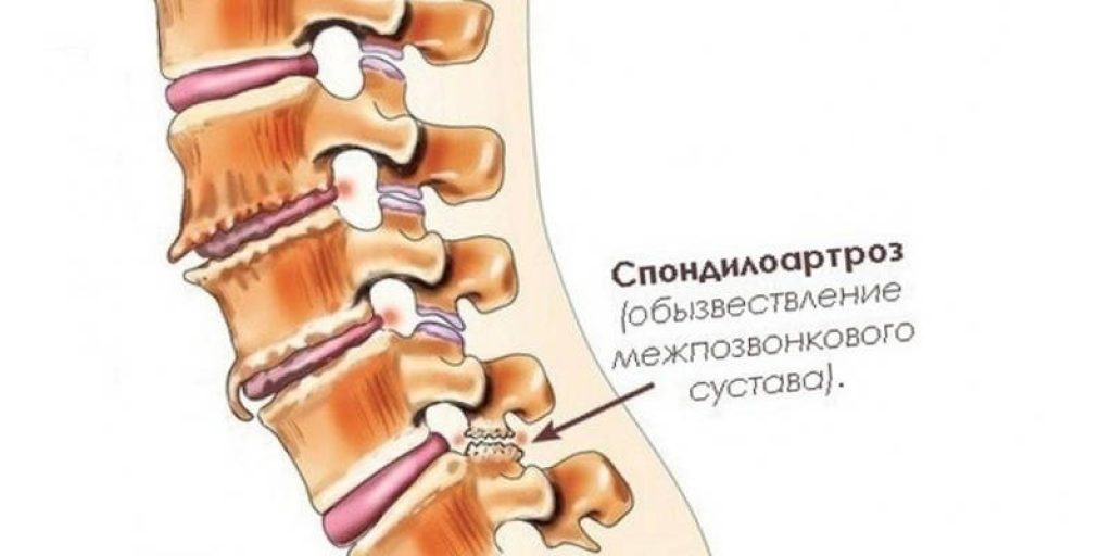 Спондилоартроз шейного отдела: как остановить развитие болезни и быть здоровым