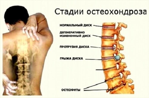 Остеохондроз 3 степени – чем опасен, методы лечения и профилактики