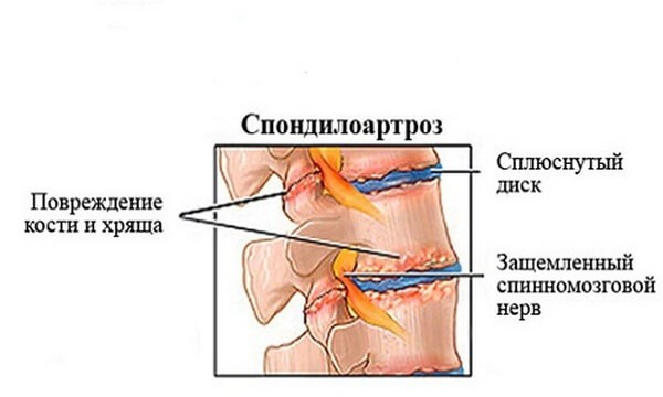 Спондилоартроз поясничного отдела позвоночника: симптомы и лечение