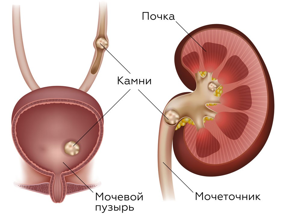 Мочекаменная болезнь