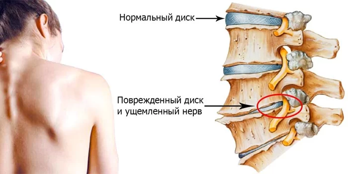 Как вылечить защемление нерва в спине?